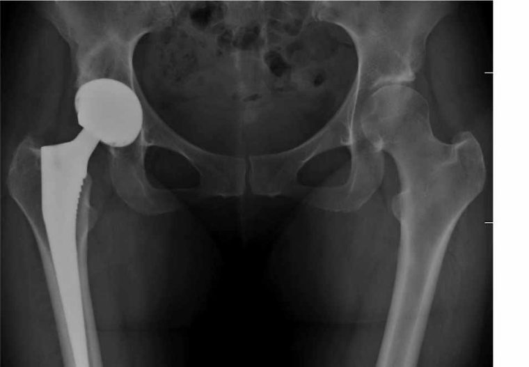 Radiografía de reemplazo de cadera