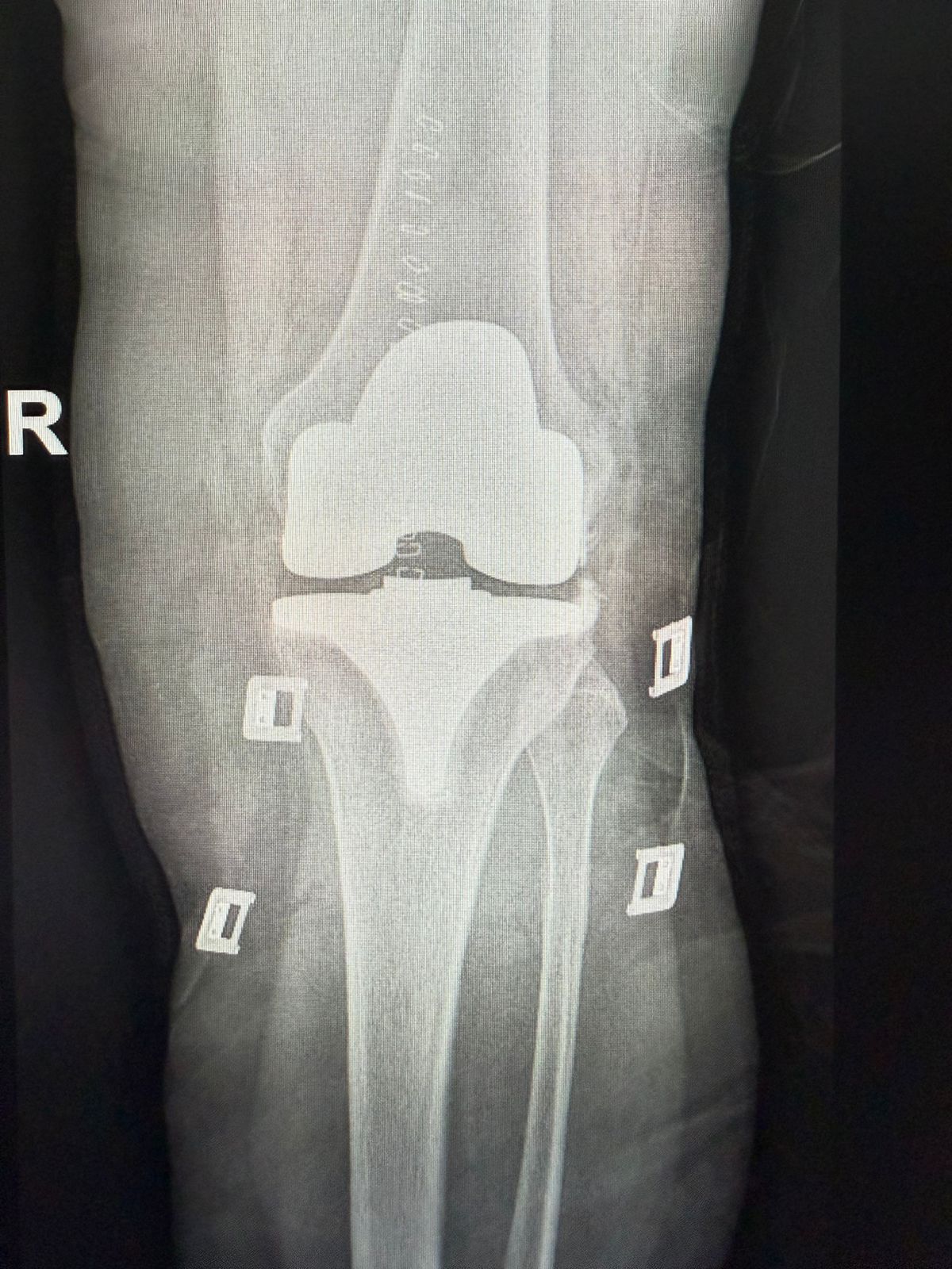 Radiografía de reemplazo de rodilla (AP)