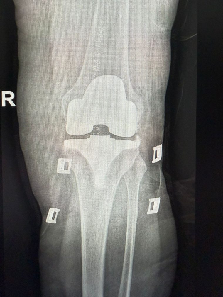 Radiografía de reemplazo de rodilla