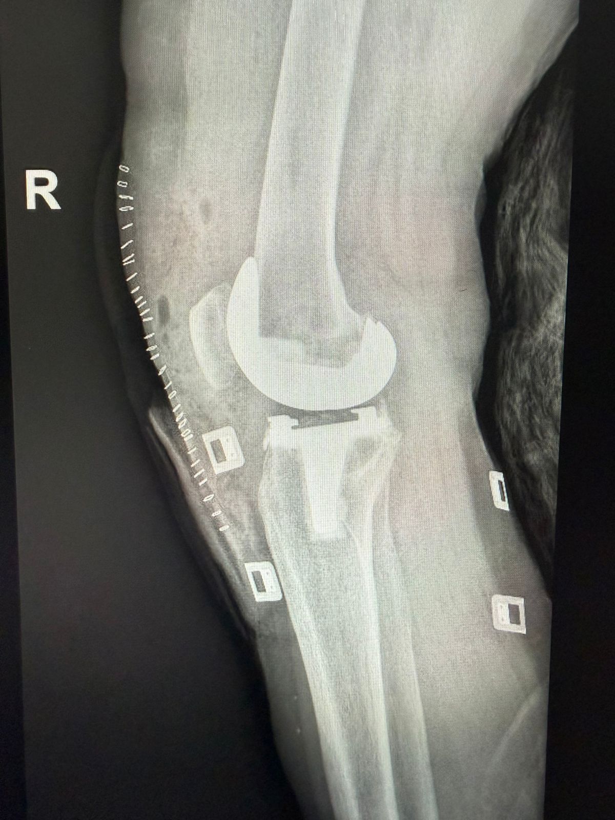 ¿Cuánto dura una prótesis de rodilla?